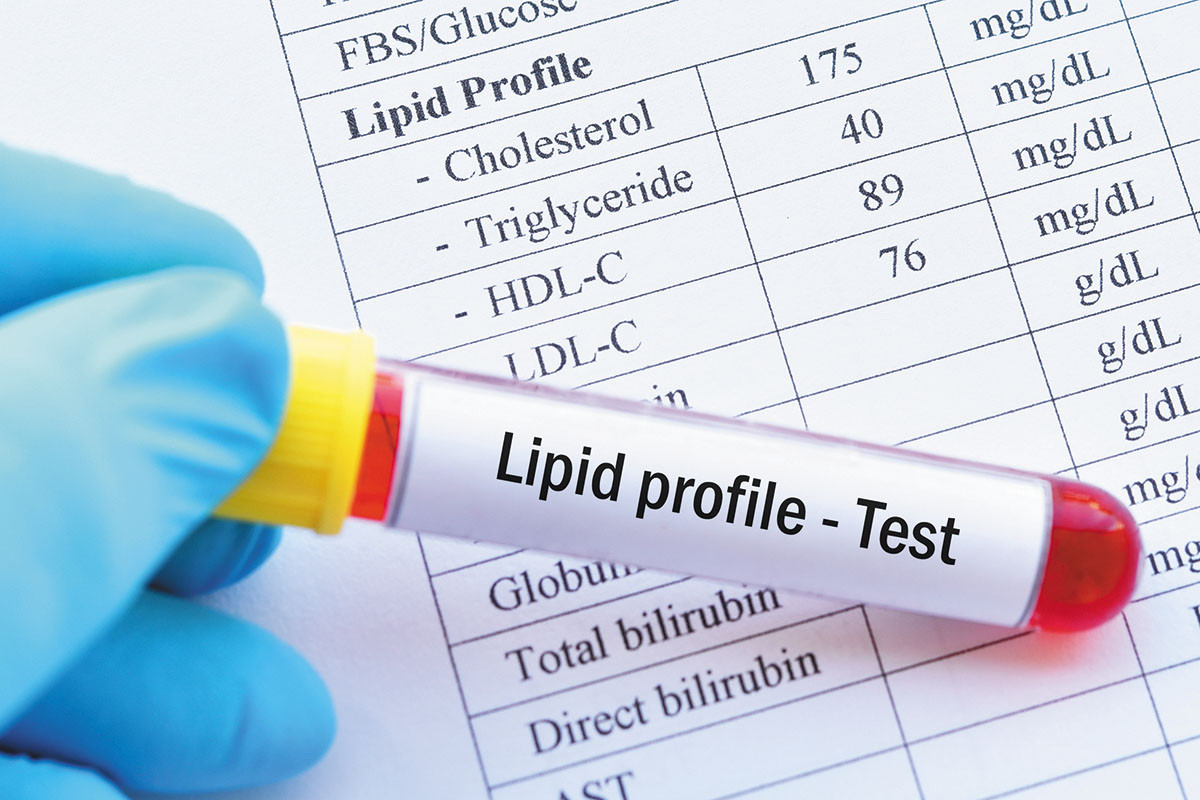 Lipid Profile Test